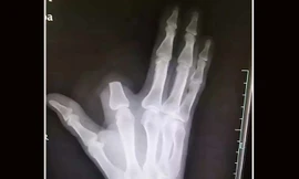 Người đàn ông Trung Quốc chặt ngón tay sau khi bị rắn cắn