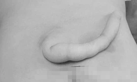 Bé trai 4 tháng tuổi có đuôi dài 14cm