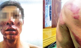 Những vết thương trên người anh S.