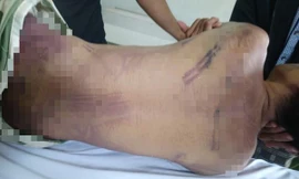 Thi thể của phạm nhân L. được phát hiện với nhiều vết bầm tím