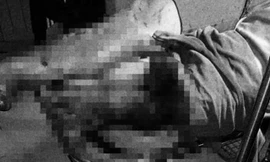 Chân của anh T. bị chém gần đứt lìa