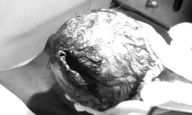 Bé trai chào đời với vết rách dài, rộng ở trên da đầu. Ảnh: Bệnh viện cung cấp