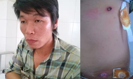 Anh Khảm trình bày sự việc và vết thương do công an thị trấn Đầm Dơi bắn. Ảnh: Dân Việt