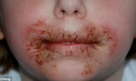 Một bé gái bị mẩn rát vùng miệng vì dị ứng chất bảo quản MI trong giấy ướt