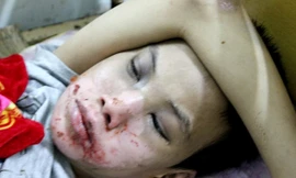 Mặt cháu Tú bị nhiều thương tích vết bỏng 