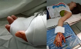 Bàn tay nạn nhân đã được bác sĩ băng bó