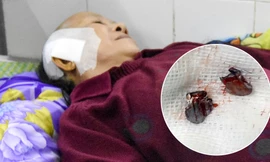 Đạn găm trúng đầu người phụ nữ