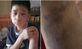 Trốn học đi đá bóng, nam sinh lớp 8 bị bố cùng mẹ kế đánh dã man