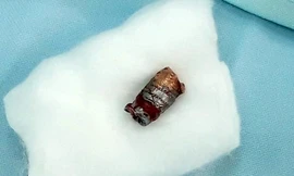 Viên đạn súng bút găm vào cổ nạn nhân được lấy ra