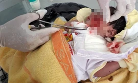 Cháu bé được các bác sĩ cấp cứu hô hấp, rửa vết thương trên mặt. Ảnh: Người Lao Động