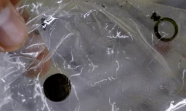 Viên pin mỏng dẹt to bằng cúc áo được lấy ra từ mũi bệnh nhân Cường. Ảnh: Ngọc Trường