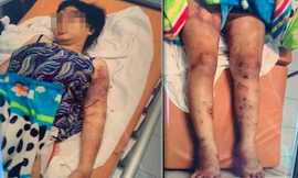 Chị Y bị hành hạ dã man và ép sử dụng ma túy đến sẩy thai