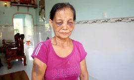 Khuôn mặt bầm tím của bà Tạo. Ảnh: Báo Bình Phước