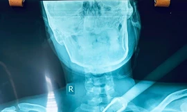 Đuổi theo kẻ trộm chó, nam sinh viên bị bắn tên xuyên cổ