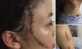 Lộ nguyên nhân cô gái 18 tuổi bị bạn dùng dao rạch mặt phải khâu hàng chục mũi