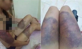 Các vết bầm tím khắp người chị Y do bị đánh đập tàn nhẫn. Ảnh: VietNamNet