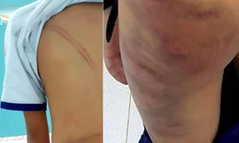 Khởi tố vụ mẹ kế đánh con chồng ở Cà Mau