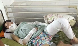 Phỏng cả người vì nhắc hàng xóm