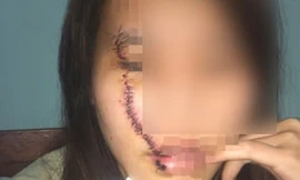 Cô gái bị rạch mặt khi ngồi sau xe máy của 'trai đã có vợ'