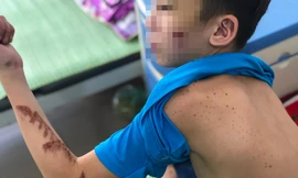 Duy đang điều trị các thương tích tại bệnh viện