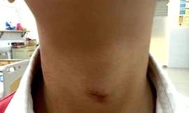 Vết thương trên cổ cháu do dây rèm cửa thít. Ảnh: Ngô Anh Vinh