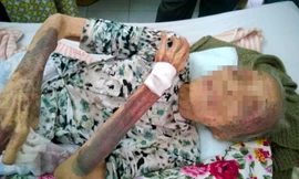 Bà Bảy vết thương thâm tím người vì con ruột đánh. Ảnh: Thanh niên