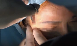 Cơ sở spa 'tiêm hộ' filler vào ngực và bụng khiến một phụ nữ nguy kịch, phải chạy ECMO?