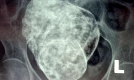 Hình ảnh khối thai đá trong cơ thể bà Sáu