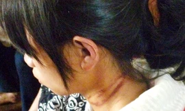 Vết thương trên cổ cháu Linh. Ảnh: Phan Thương