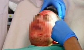 Sau li tâm, phần huyết tương tiểu cầu (phần ở giữa) sẽ được tiêm vào da