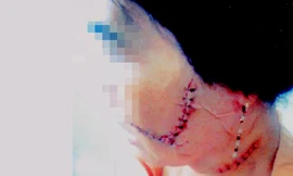 Bà LTT với các thương tích trên mặt do bị rạch bằng dao lam. Ảnh: Tấn Lộc