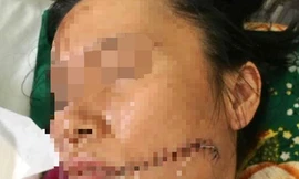 Ngoài vết bỏng 60% chị Mai còn bị vết thương khâu 20 mũi