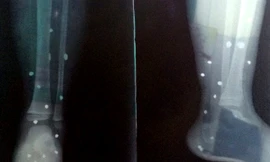 Bé 4 tuổi nhập viện vì trúng loạt đạn hoa cải