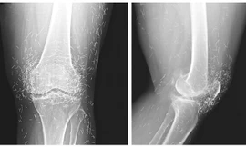 Phim chụp X-quang cho thấy, đầu gối của người bệnh có hàng trăm kim châm cứu bằng vàng