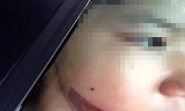 Vết bỏng trên mặt bé Thảo vào cuối tháng 11/2017