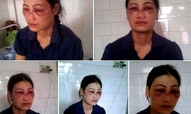 Chị Hoa với đầy thương tích trên khắp cơ thể sau khi bị chồng bạo hành