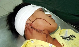 Đứng ra can ngăn nhưng anh Hoàng bị Hùng bắn vào trán gây thương tích - Ảnh có tính chất minh họa