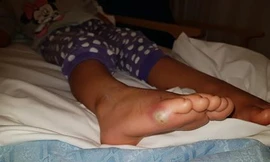 Bé gái không đi tất thử giày và đã bị nhiễm khuẩn dẫn tới nhiễm trùng máu.