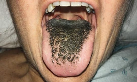 Lưỡi mọc lông có thể là tác dụng phụ của thuốc tây y.