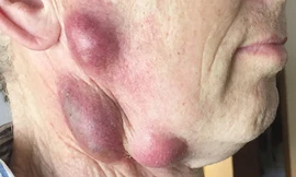 Cổ của người chủ nuôi mèo bị sưng phồng khi chú mèo yêu của ông bị chết vì bệnh bạch cầu.