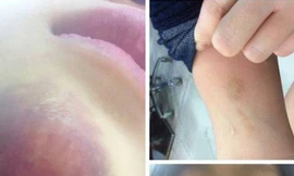 Vết thương trên cằm và tay nữ hành khách Q.A