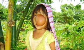 Phẫu thuật thành công ca thoát vị não hiếm gặp