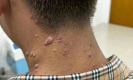  Đồng Nai: Nam thanh niên 17 tuổi nghi mắc đậu mùa khỉ 