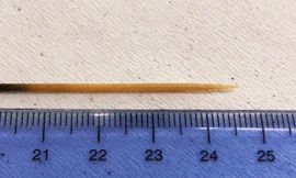 Suýt chết vì chiếc tăm 'chu du' trong ổ bụng