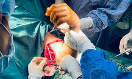 Nối thành công cánh tay bị đứt lìa