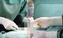 Liệt 'cậu nhỏ' vì bơm silicon làm to