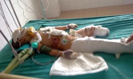 Cháu bé trong vụ nổ xe khó qua cơn nguy kịch