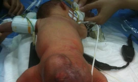 Bệnh nhi và khối u hiếm gặp vừa được BV Sản-Nhi Đà Nẵng phẫu thuật thành công. Ảnh: Nguyễn Huy