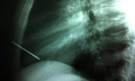 Đinh 8 cm đâm vào tim vẫn sống