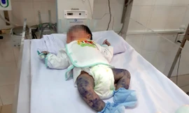Cứu sống bé trai 13 ngày tuổi bị thủy đậu hiếm gặp 